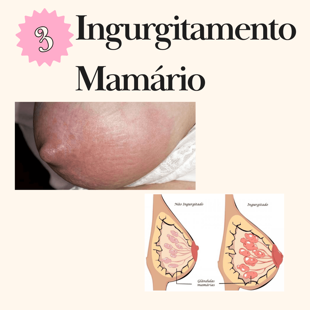 Ingurgitamento mamário
