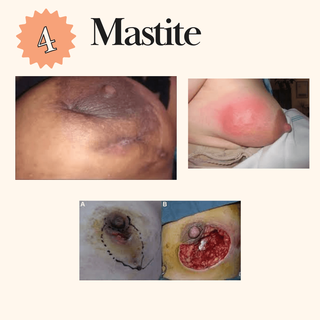 Mastite